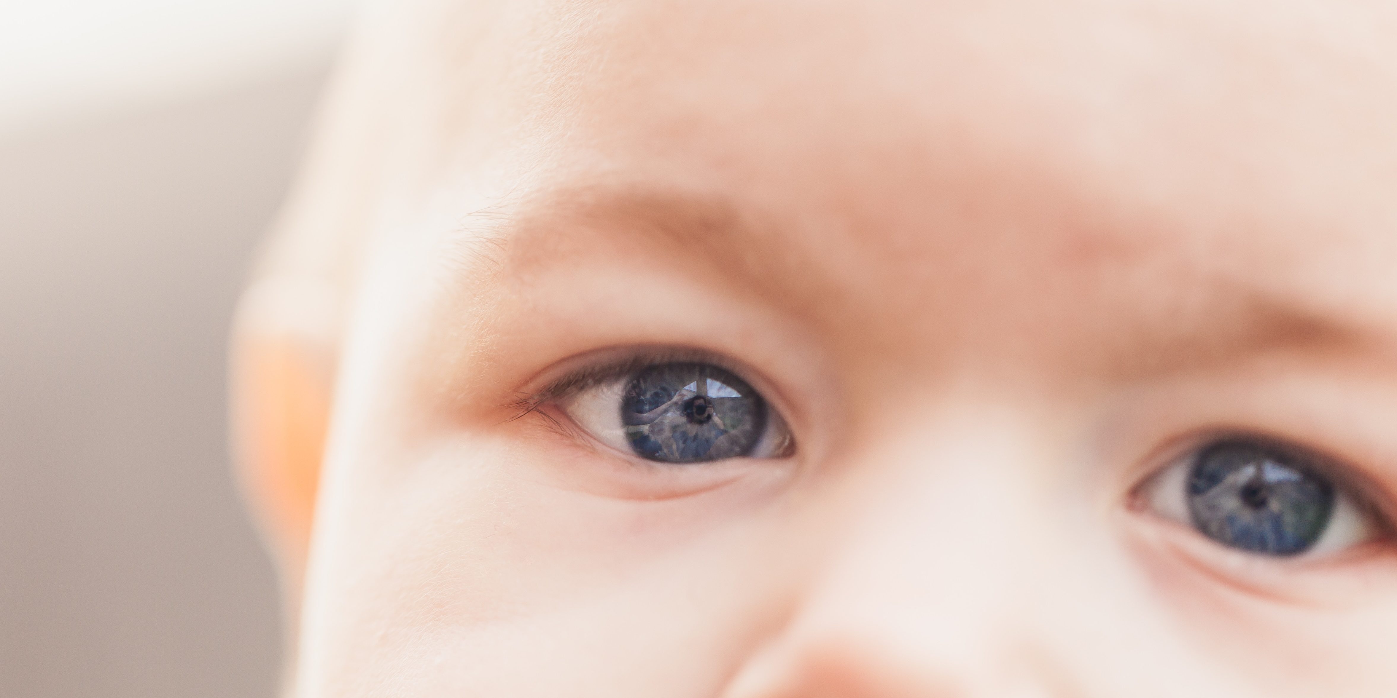 What is a rare eye condition in children?