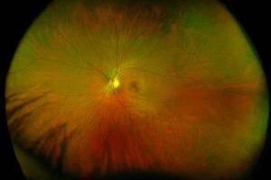 Green and red scan of eye showing optical nerve