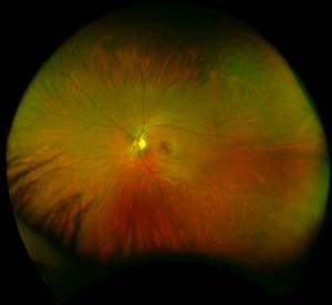 Green and red scan of eye showing optical nerve