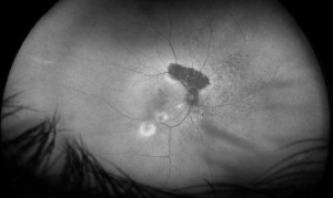 Scan of eye showing optical nerve